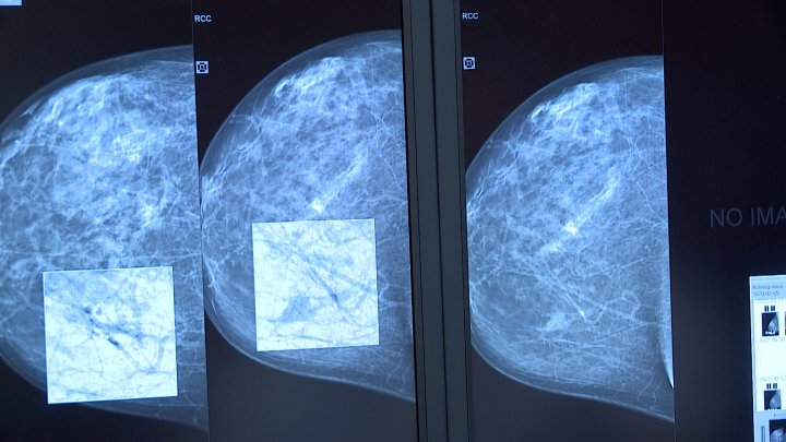 Se puede hacer mamografia cada 6 meses